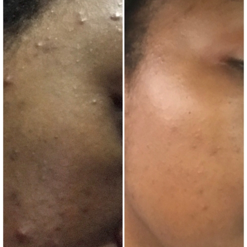 Cassie Daves before and after with Korean skincare